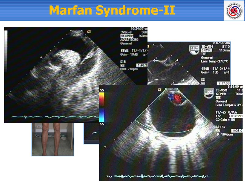 Marfan Syndrome-II